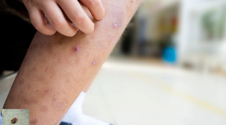 Ágyi poloska csípés kezelése